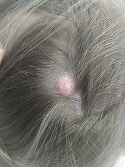 sebaceous cyst scalp